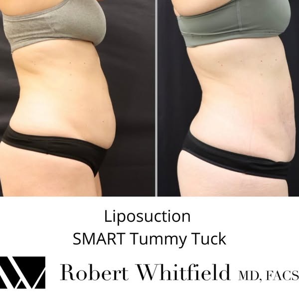 Before and after abdominal contour following a SMART Tummy Tuck combined treatment (liposuction, BodyTite, and Morpheus8) performed by Robert Whitfield, MD.